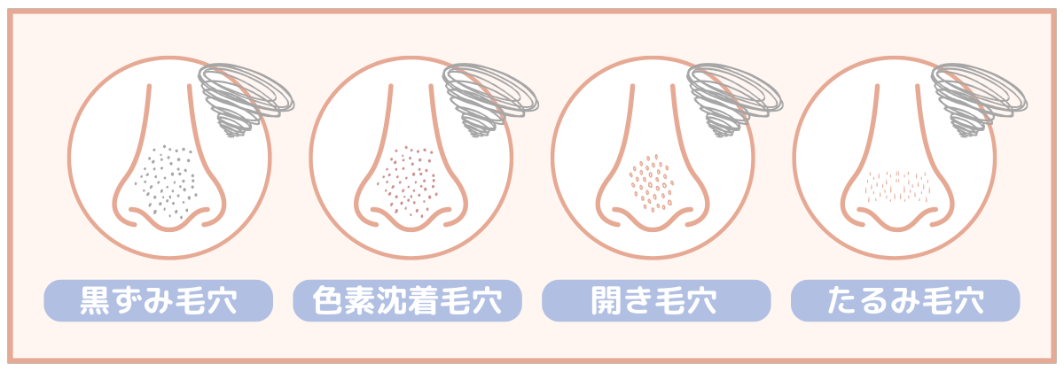 黒ずみ毛穴｜色素沈着毛穴｜開き毛穴｜たるみ毛穴